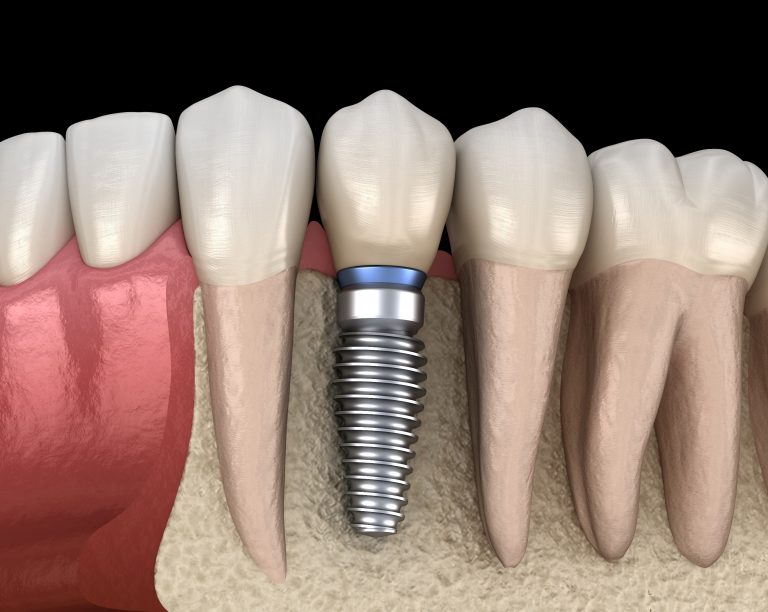 Connection Between Bone Grafting and Dental Implant Success David ...